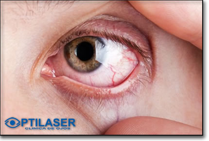 Clinica de ojos Optilaser - Glaucoma